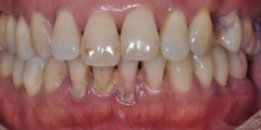 右上後牙咬物疼痛壹周-慢性牙周炎治��案例