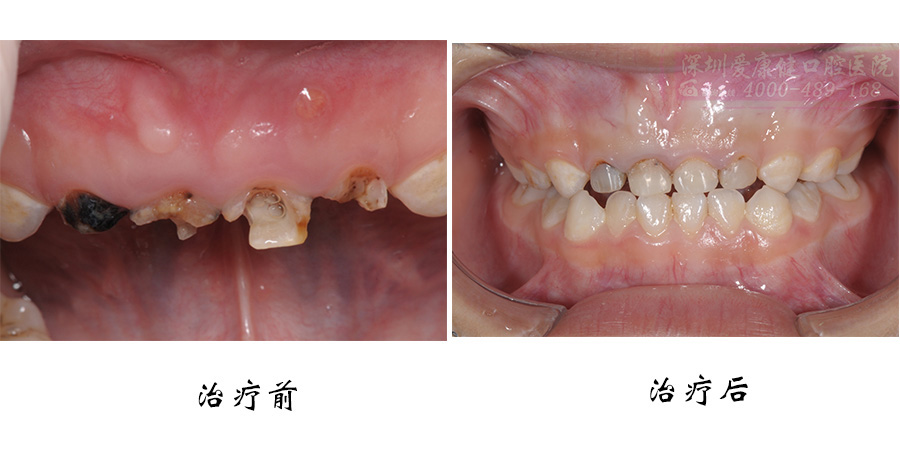 乳前牙�x��,根尖周炎,�貉栏�管治��案例