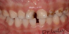 �l�F上前牙呈黑色3月余-�和��x�X填充案例