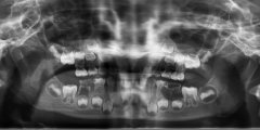 左下後牙反�湍[痛-拔乳牙��根案例