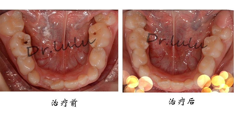 乳後牙食物嵌塞半年余-牙髓摘除�g及充填�g案例