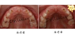  乳後牙食物嵌塞半年余-牙髓摘除