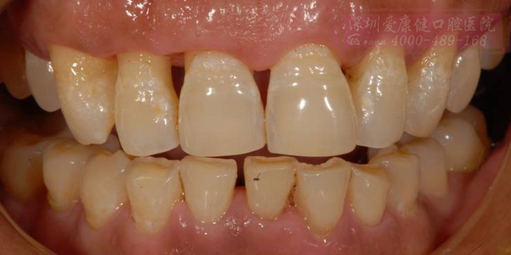 牙�l萎�s,牙�X松��,慢性牙周炎