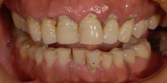 牙�l萎�s、牙�X松��-慢性牙周炎治��案例