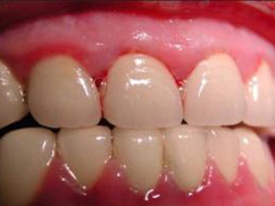 牙�l炎治��方法有哪些