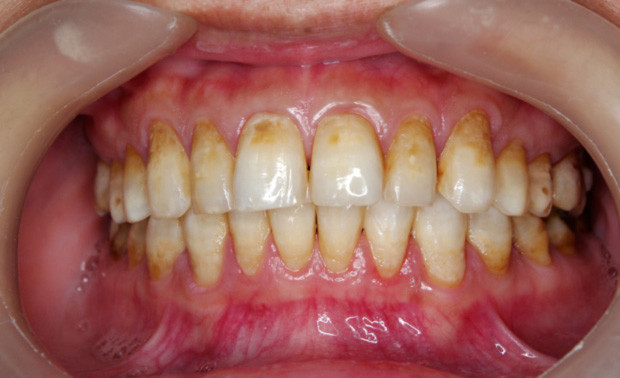 氟斑牙的治��方法有哪些