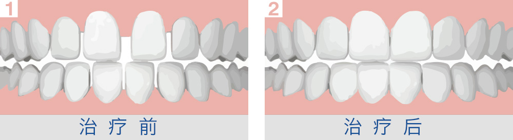 �C正牙�X稀疏的方法有哪些