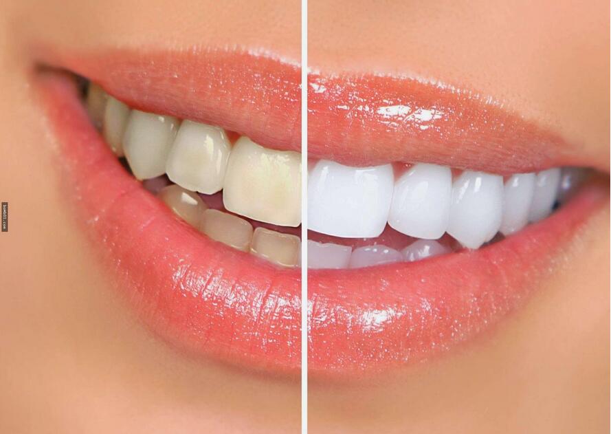 氟斑牙可以做冷光美白��