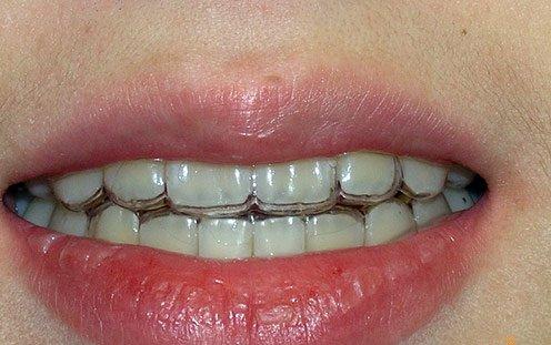 成人牙�X稀疏的原因是什麽