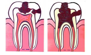 慢性牙髓炎怎麽治��