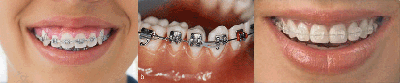 牙周炎患者能做牙�X�C正�幔�
