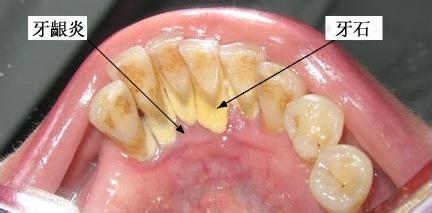 怎麽防止牙�Y石的形成