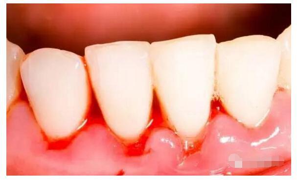 牙�l老是出血是什麽原因