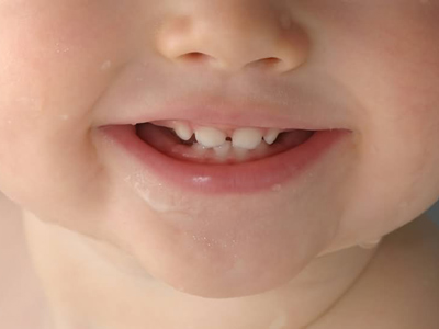 乳牙蛀牙了，到底需不需要治��？