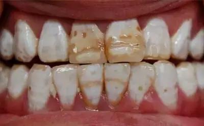 氟斑牙能否刷白，洗白?