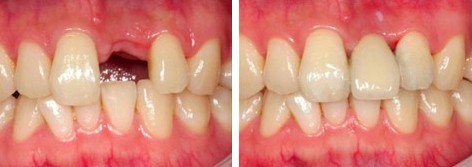 牙�X缺失危害大，�槭谗��缺壹少三呢？