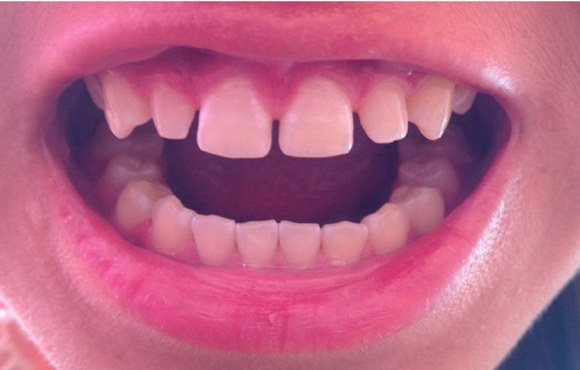 牙�p大是洗牙造成的？
