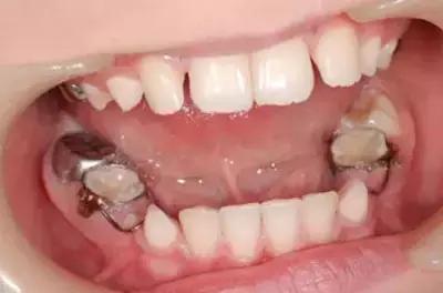 �和�乳牙�落可以使用�g隙保持器治����