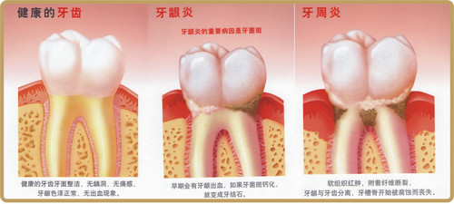 牙�l炎和牙周病有哪些�^�e