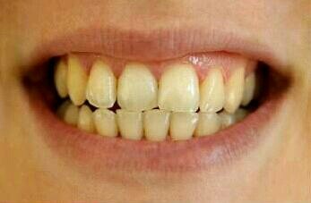 牙�X��S的影�因素有哪些