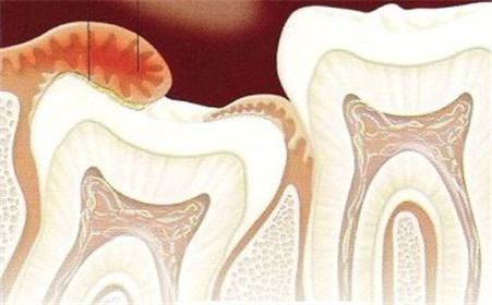 牙�l炎如何防治
