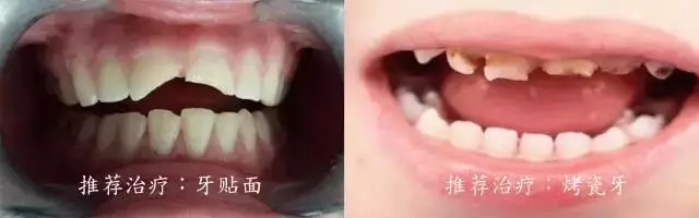 牙�N面