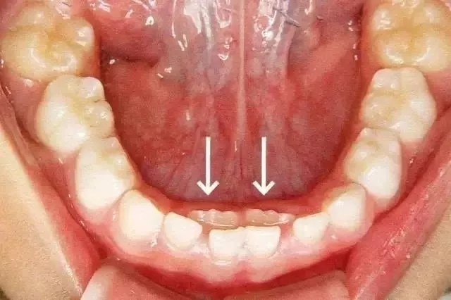 乳牙��留