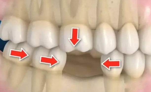 牙齿缺失导致邻牙拥挤